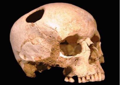 Trepanated skull